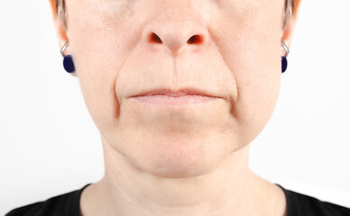 Swollen cheek from wisdom tooth extraction on day 3. Close up of woman with swollen face. Cheek...