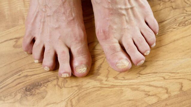 Toenails with fungal infection. Onychomycosis. Fungal infection of nails feet close-up. Adult man scratching toe with fungus. Fungus infection on nails of man's foot close-up