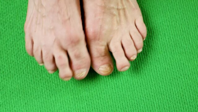Varicose veins on a male legs. Feet of an old man with mutilated sick nails. Fungus infection on nails of man's foot . Toenails with fungal infection. Scratching your sore feet. Green background,