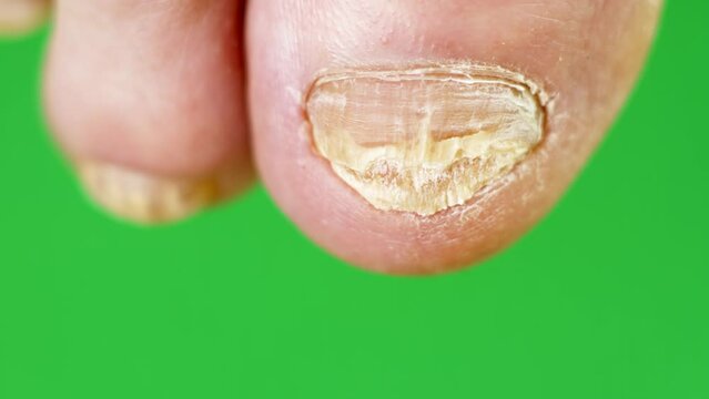 Fungus infection on nails of man's foot close-up. Mycosis. Disfigured toenail due to skin disease. Hygiene and health care. Green background. 
Fungal nail disease and on the legs.