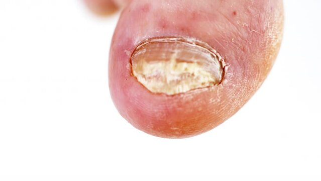 Fungal infection of nails feet close-up. Infected toes with fungus and unpleasant odor. White man's sore feet. Hygiene and health care. 
Toenails with fungal infection. Onychomycosis. 