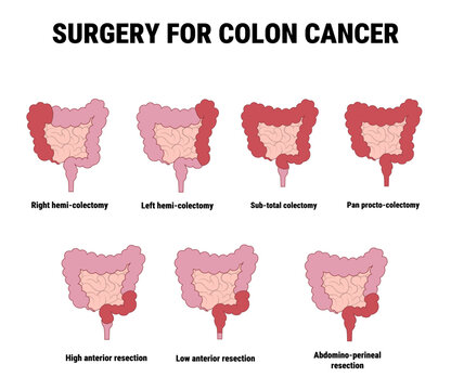 surgery for colon cancer diagram