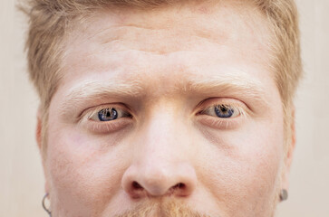 Close up portrait of an albino latino man