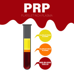 Vector illustration of test tube filled with blood after centrifugation of whole blood for PRP therapy vector illustration.
