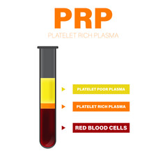 Vector illustration of test tube filled with blood after centrifugation of whole blood for PRP therapy.