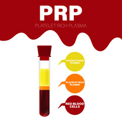 Vector illustration of test tube with blood after centrifugation of whole blood for PRP therapy vector illustration.