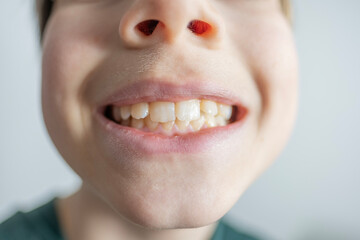 child 12 years old shows tooth sways and hurts, concept pediatric dentistry, dental treatment and...