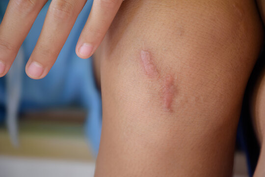 Scar is inflamed and red called keloids on children knee close-up in body parts blurred background concept of skin and wound for medical healthy skin care.