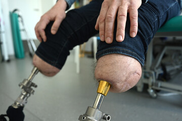 a man with bone-implanted leg prostheses. osteointegration