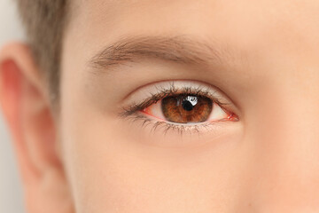 Obraz premium Little child suffering from conjunctivitis, closeup view