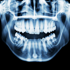 Comprehensive Panoramic Dental X-Ray Highlighting Teeth