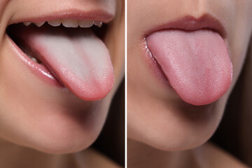 Woman showing her tongue before and after cleaning procedure, closeup. Tongue coated with plaque on one side and healthy on other, collage