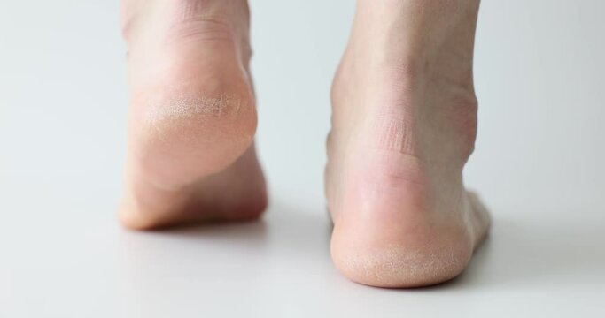 Bare feet with calluses and corns and dry skin closeup 4k movie slow motion. Treatment of flat feet concept