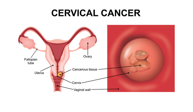 Cervical cancer illustration Vaginal cancer