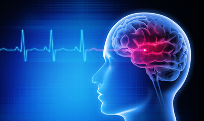 Medical 3D illustration of a man with stroke symptoms