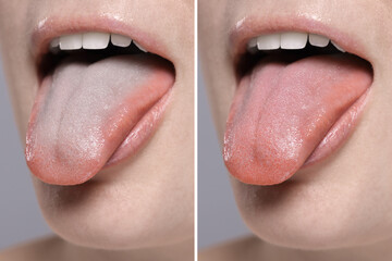 Woman showing her tongue before and after cleaning procedure, closeup. Tongue coated with plaque on...