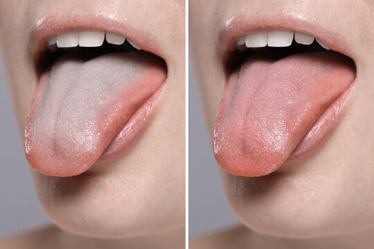 Woman showing her tongue before and after cleaning procedure, closeup. Tongue coated with plaque on one side and healthy on other, collage