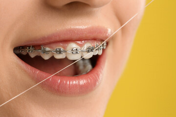 Woman with braces cleaning teeth using dental floss on yellow background, closeup