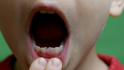 Close up, boy opens his mouth and shows his milky teeth. One missing tooth replaced with permanent...
