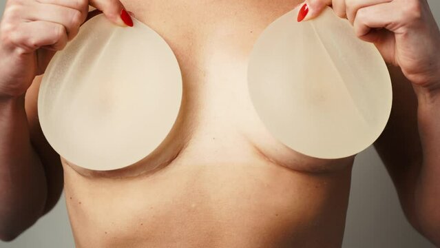 Surgical Journey: Woman Displays Removed Breast Implants