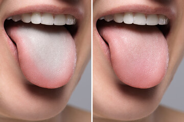 Woman showing her tongue before and after cleaning procedure, closeup. Tongue coated with plaque on...