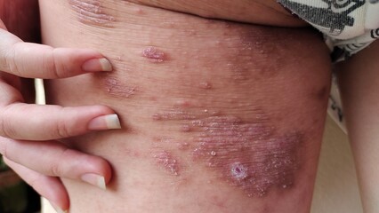 close up the rash hives allergy, allergic and reaction, scar and acne, irritated and wound on the...