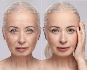 Portrait of an elderly woman before and after skin resurfacing and cosmetic procedures.