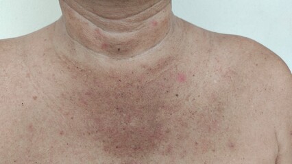 Naklejka premium Portrait the wrinkle and Flabby skin, rash hives allergy and inflammation skin, scar and acne, blemish and freckles on the body of the male patient, health care and medical concept.