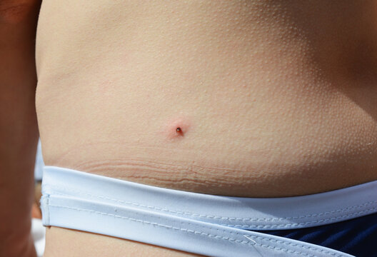 A tick bite on a girl's back a transmitter of lyme and borrelia disease.