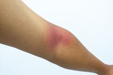 Insect bite on human skin. Swollen mosquito bite. man hand skin turned and scratching bitten