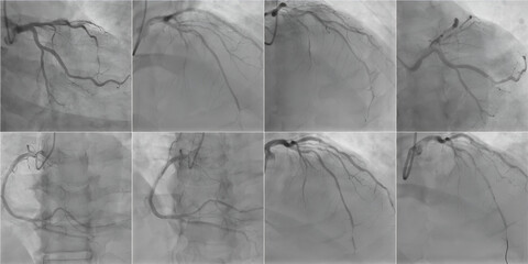 Cardiac Artery Imaging: Coronary angiogram Analysis for Diagnostic Insights