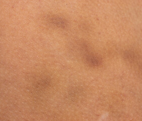 blue bruise on the skin of the arm.