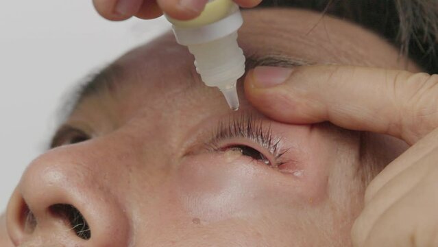 Senior man use antibiotic eye drops to treat swollen eye from insect bite.