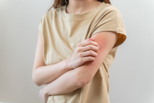 young woman scratching on her arm and has a red rash irritation on her skin from dust intolerance.
