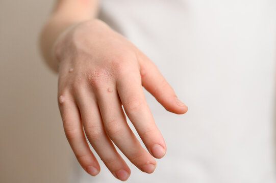 Many warts on child hand, flat wart, close-up, Verruca vulgaris. Human papillomavirus, HPV. Pediatric dermatology concept, getting rid of warts, one day surgery.