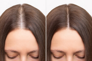 Before and after head shot of a young woman with a receding hairline on her forehead and parting....