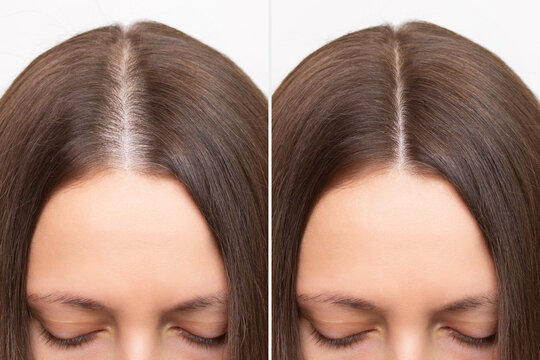 Before and after head shot of a young woman with a receding hairline on her forehead and parting. Baldness. Close-up, front view. Hair care and treatment concept. Hair loss, hair transplant, alopecia