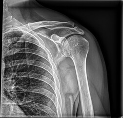 X-Ray Radiography of an injured left shoulder