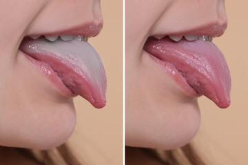 Woman showing her tongue before and after cleaning procedure, closeup. Tongue coated with plaque on...