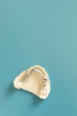Mockup Metal Frame Lower Partial Denture, Plate On Die Stone, Plaster Cast Mold Of Lower Jaws,...