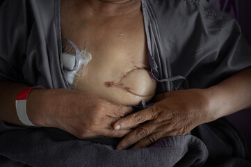 Medical concept: Close up picture of the patient's hand cancer survivor showing mastectomy scar