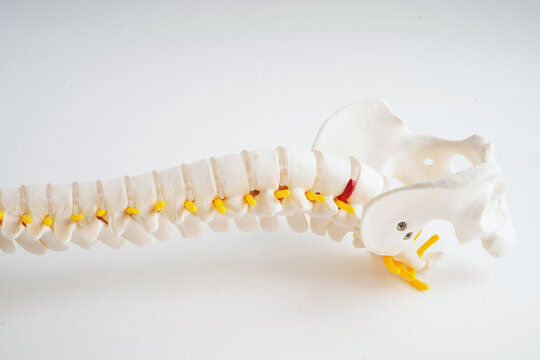 Spinal nerve and bone, Lumbar spine displaced herniated disc fragment, Model for treatment medical in the orthopedic department.