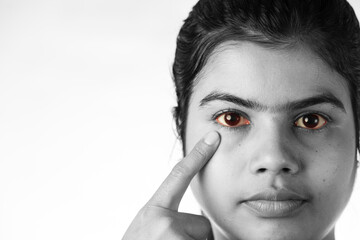 yellow eye - symptom for health problem