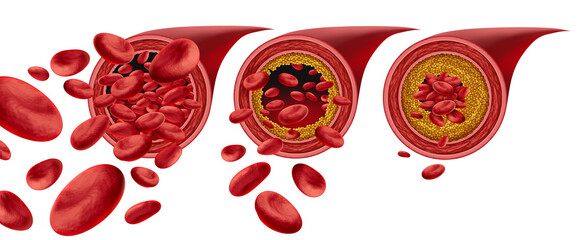 Atherosclerosis Plaque Formation and Clogged arteries disease medical concept with blood cells that is blocked by buildup of cholesterol as arteriosclerotic vascular diseases.