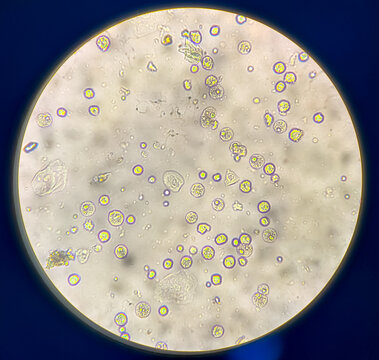 Pyuria or leukocyturia is the condition of urine containing white blood cells or pus. It can be a sign of a bacterial urinary tract infection.Micrograph