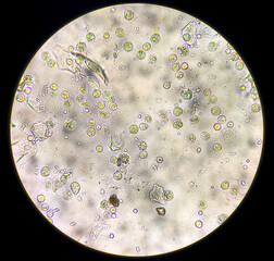 Pus cells (WBC), Red blood cells (RBC) and occasionally epithelial cells in urine sediment analysed...