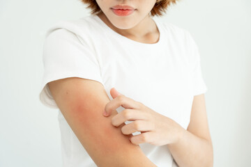 skin problem and beauty. Young woman scratch body has itchy skin from skin allergic, steroid...