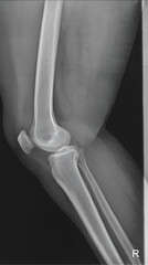 Right Knee Joint Lateral View: Comprehensive Radiographic Evaluation for Diagnostic Precision.	
Submitted 