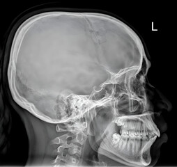 X-ray Image of Human Skull Lateral View for Diagnosis Skull Fracture.