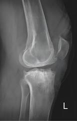 X-ray of knee and leg. X ray of human